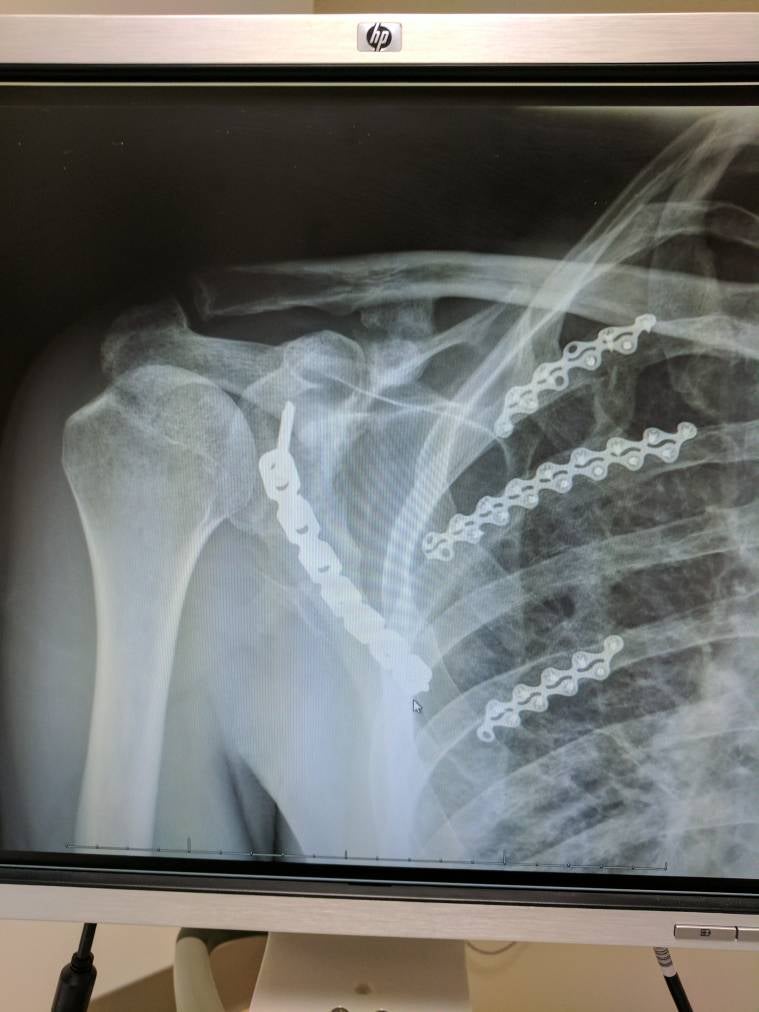 Fractured Scapula Mountain Bike Reviews Forum