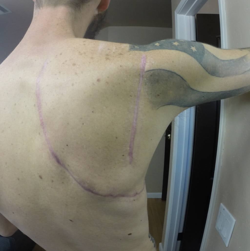 Fractured Scapula Mountain Bike Reviews Forum