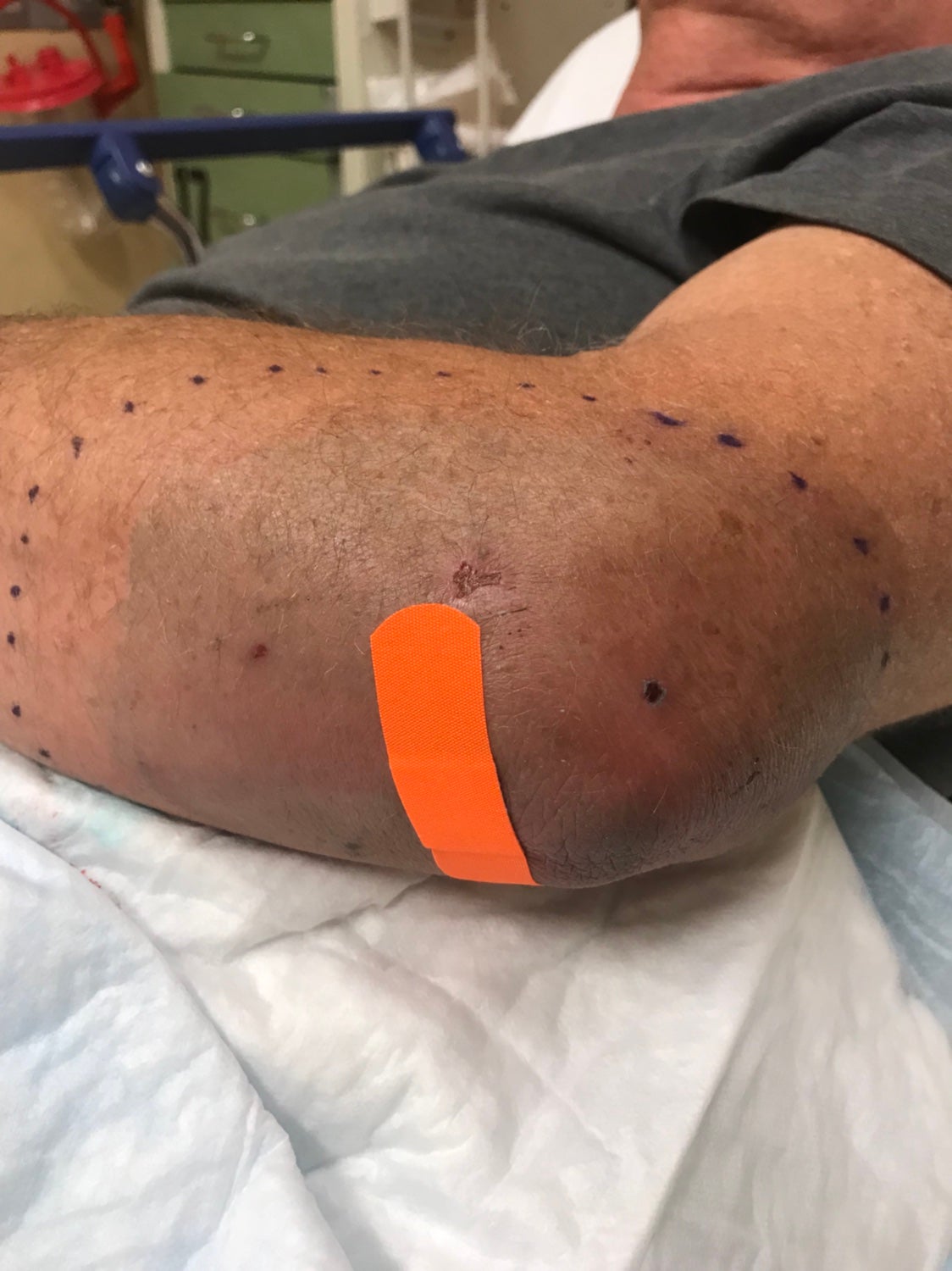 Bursitis of the left elbow, Bursa& Cellulitis of the upper left